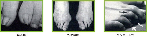 合わない靴によって生じる障害