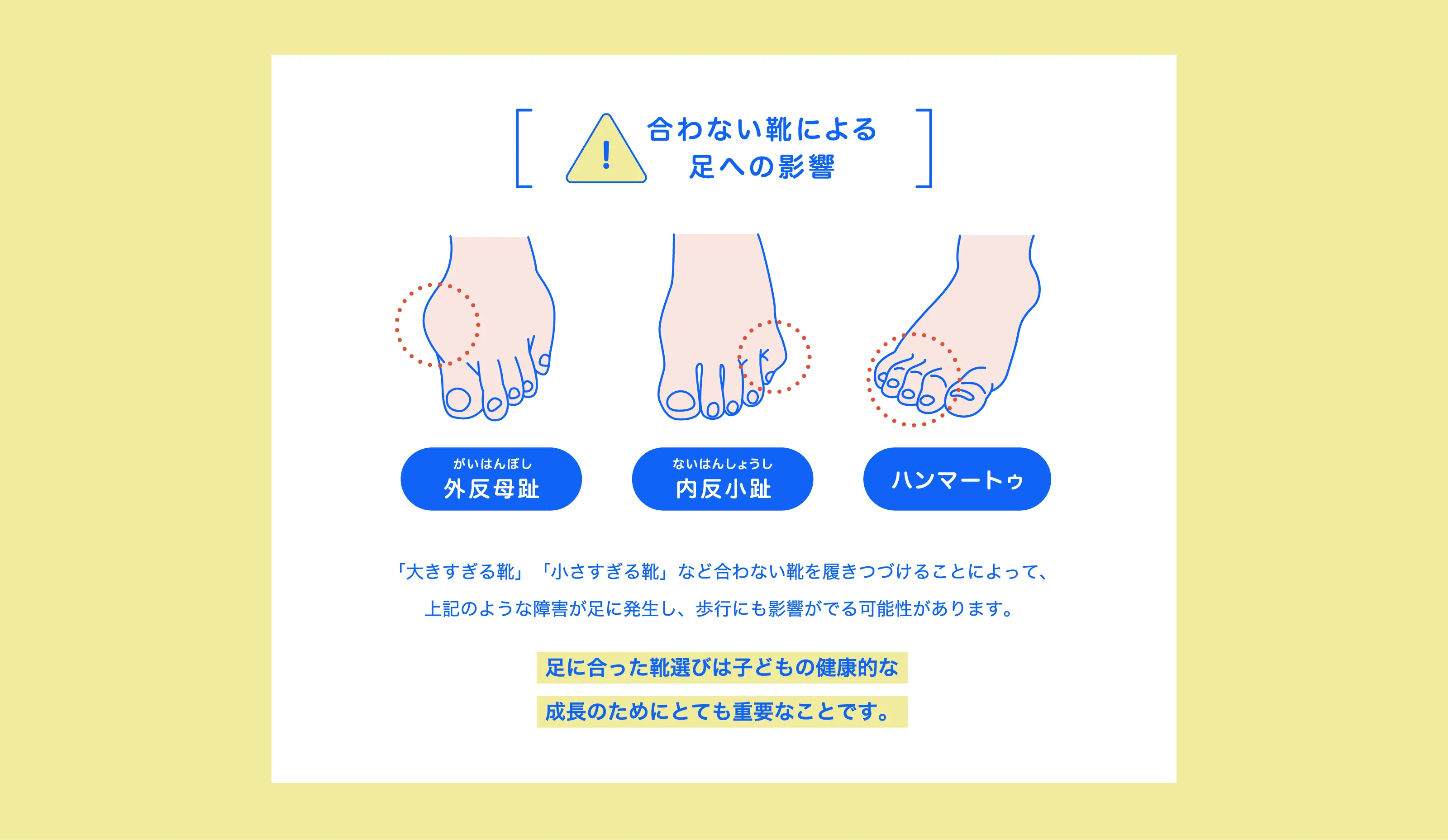 合わない靴による足への影響