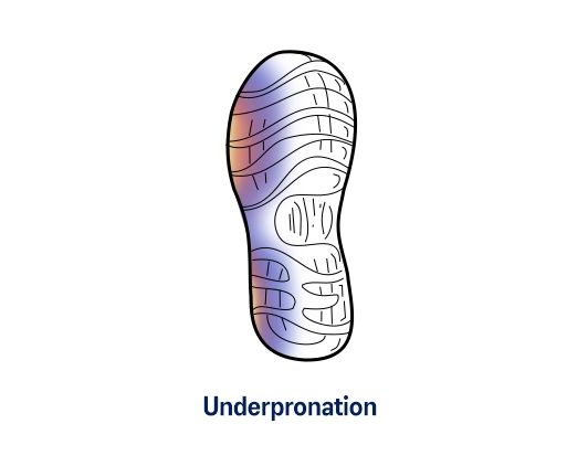 Under Pronation Shoe Wear Pattern