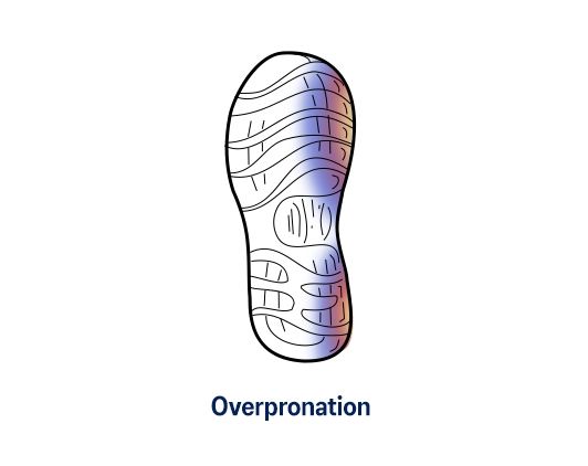 Over Pronation Shoe Wear Pattern