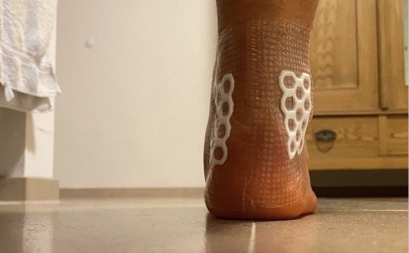 ASICS FrontRunner Achillessehnen OP und wie geht es weiter