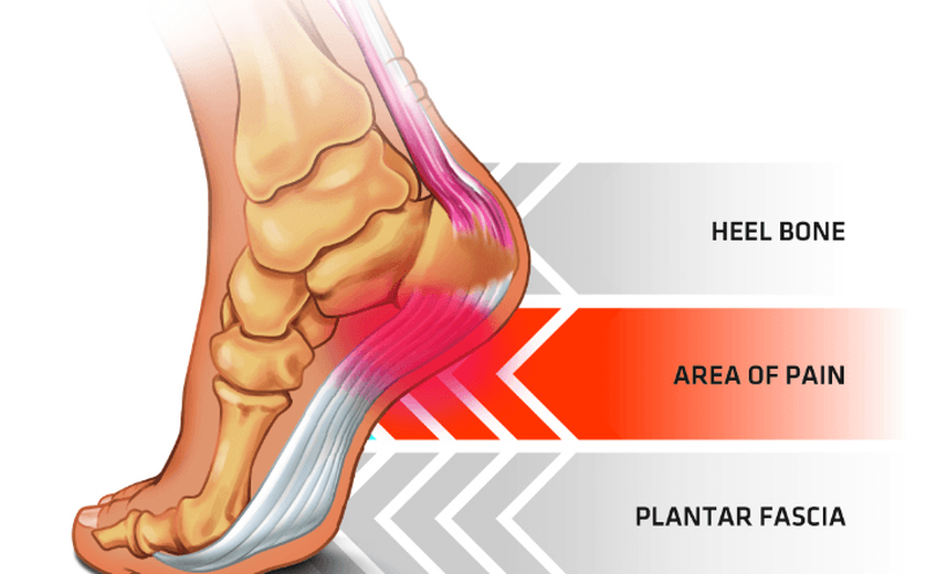 asics planters fasciitis